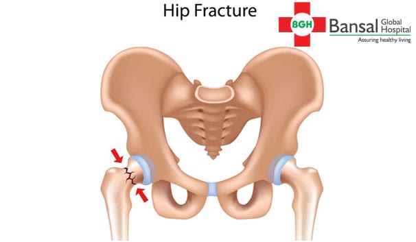Hip-Fracture