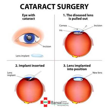 Cataracts-Treated