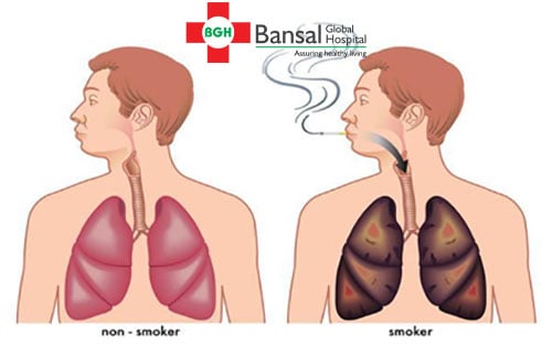 Chronic Smoker Lung