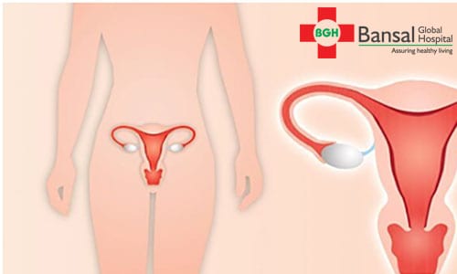 Uterus Removal in Bansal Global Hospital | Gynaecologist Experts
