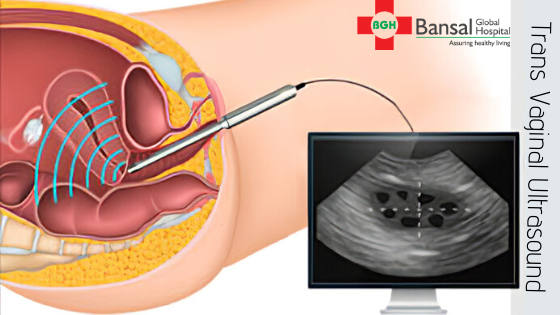 Uses Transvaginal Ultrasound | Bansal Global Hospital