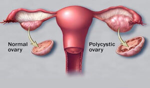 Polycystic Ovary Syndrome (PCOD) Image