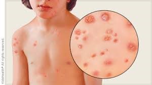 Chickenpox in Children