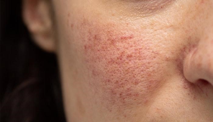 What treatment is available for Rosacea?